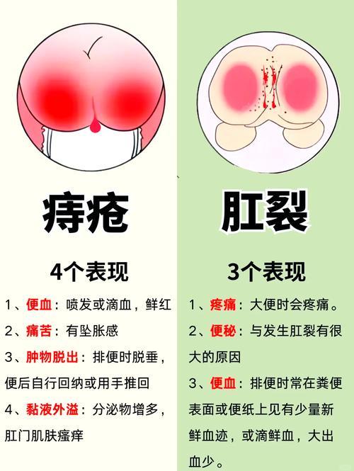 如何区分痔疮和肛裂？长沙东大肛肠医院医生来教你